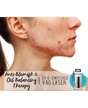 Treatment Voucher - Anti-Blemish & Oil Balancing Therapy with ER Q-Switched YAG Laser