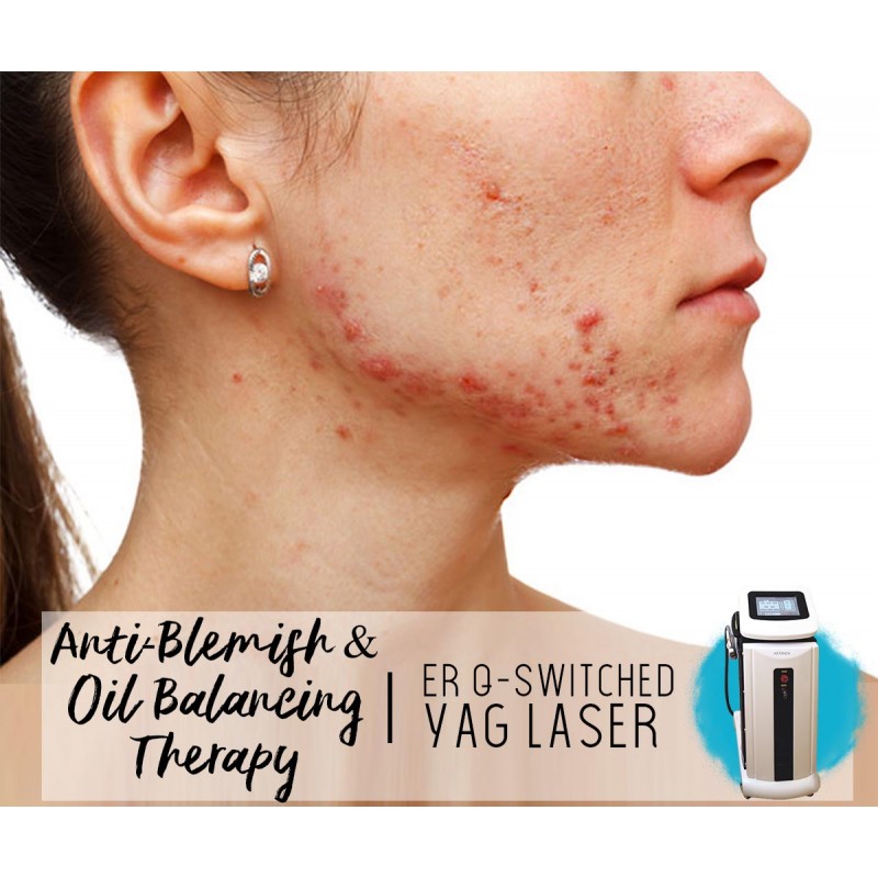 Treatment Voucher - Anti-Blemish & Oil Balancing Therapy with ER Q-Switched YAG Laser