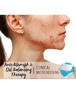 Treatment Voucher - Anti-Blemish & Oil Balancing Therapy with Clinical Micro Needling