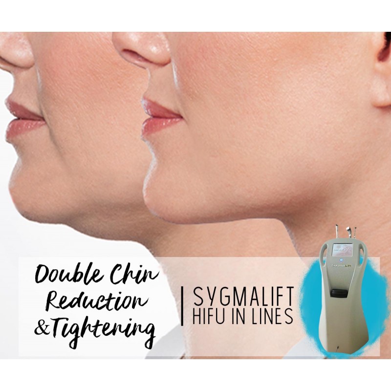 Treatment Voucher - Double Chin Reduction & Tightening with SygmaLift