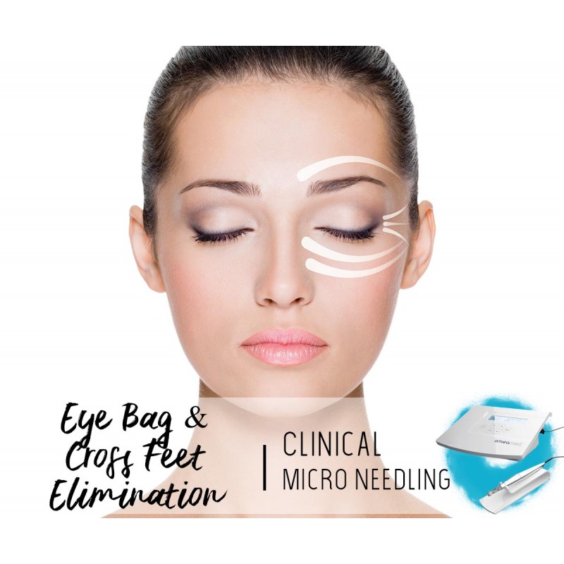 Treatment Voucher - Eye Bag & Cross Feet Elimination with Clinical Micro Needling