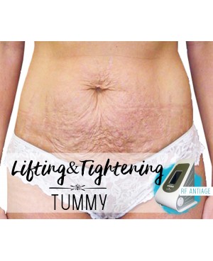 Treatment Voucher - Lifting & Tightening (Tummy) with RF Antiage Transdermotherapy