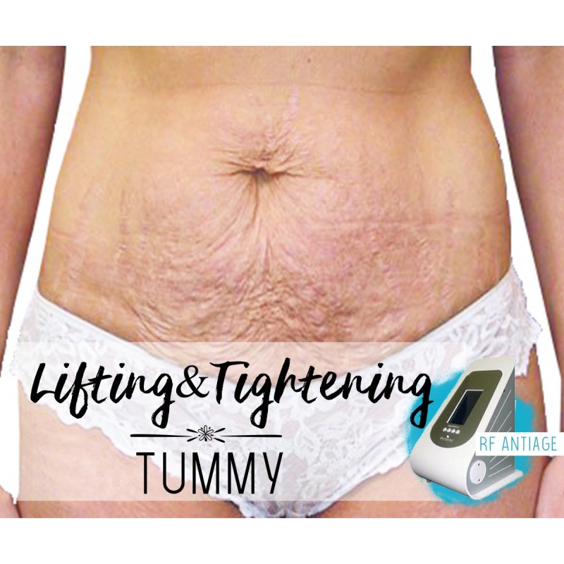 Treatment Voucher - Lifting & Tightening (Tummy) with RF Antiage Transdermotherapy