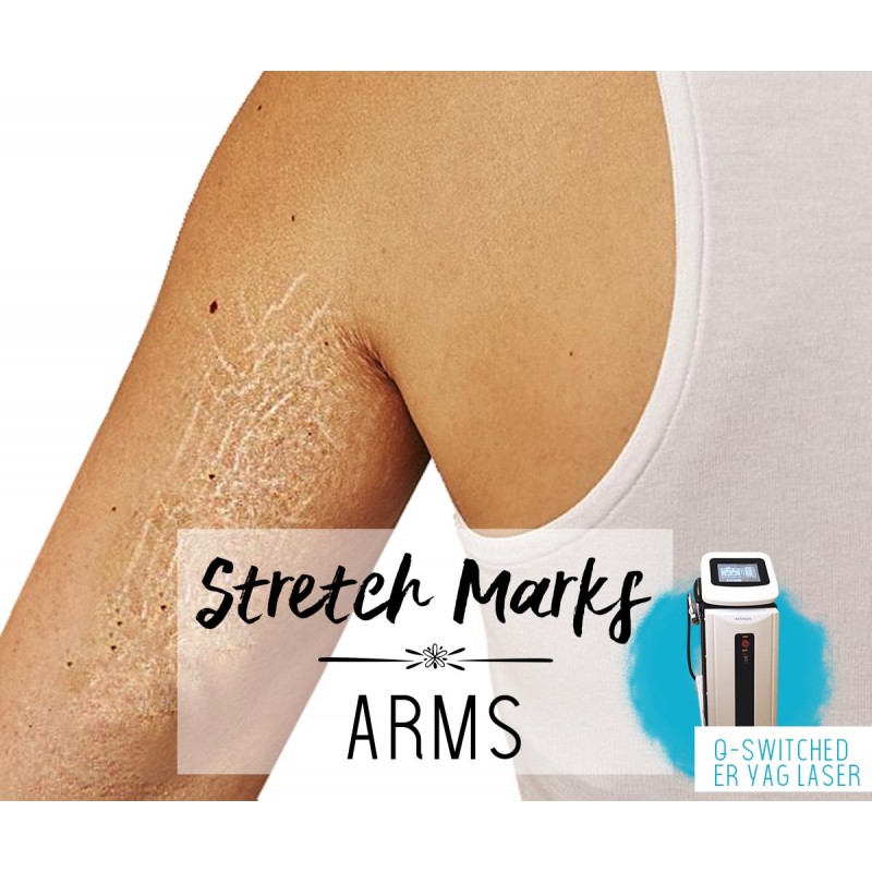 Treatment Voucher - Stretch Marks Removal (Arms) with ER Q-Switched YAG Laser