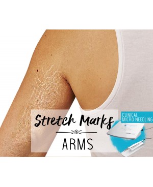 Treatment Voucher - Stretch Marks Removal (Arms) with Clinical Micro Needling