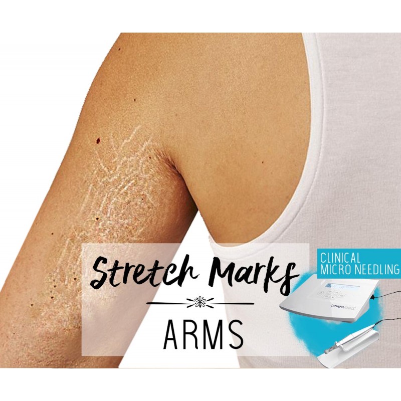 Treatment Voucher - Stretch Marks Removal (Arms) with Clinical Micro Needling