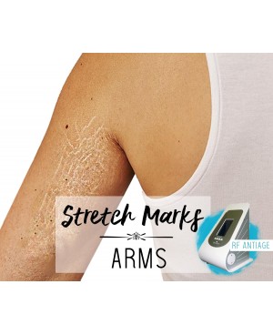 Treatment Voucher - Stretch Marks Removal (Arms) with RF Antiage