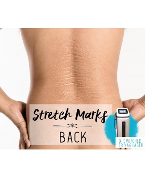 Treatment Voucher - Stretch Marks Removal (Back) with ER Q-Switched YAG Laser