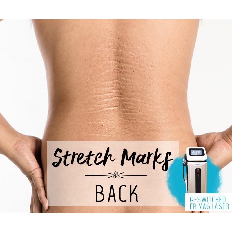 Treatment Voucher - Stretch Marks Removal (Back) with ER Q-Switched YAG Laser