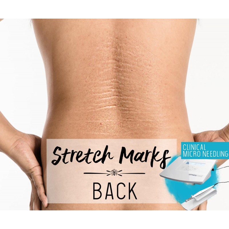 Treatment Voucher - Stretch Marks Removal (Back) with Clinical Micro Needling