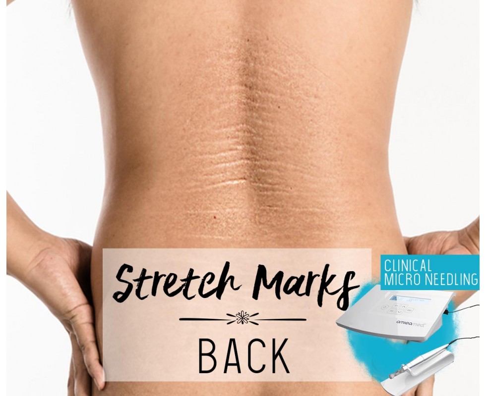 Treatment Voucher - Stretch Marks Removal (Back) with Clinical Micro Needling