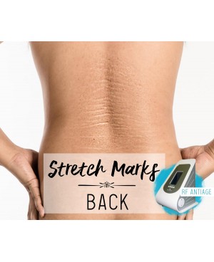 Treatment Voucher - Stretch Marks Removal (Back) with RF Antiage
