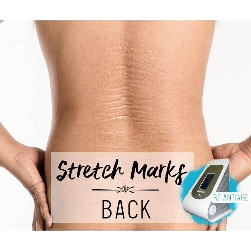 Treatment Voucher - Stretch Marks Removal (Back) with RF Antiage