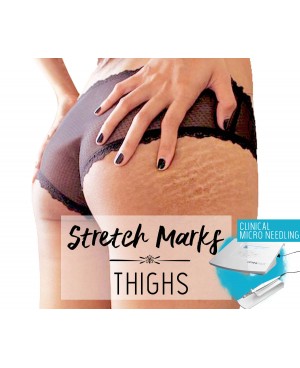 Treatment Voucher - Stretch Marks Removal (Thighs) with Clinical Micro Needling