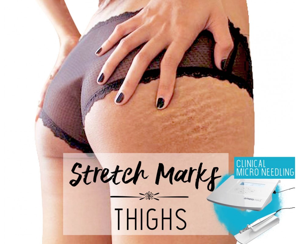 Treatment Voucher - Stretch Marks Removal (Thighs) with Clinical Micro Needling