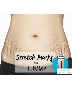 Treatment Voucher - Stretch Marks Removal (Tummy) with ER Q-Switched YAG Laser
