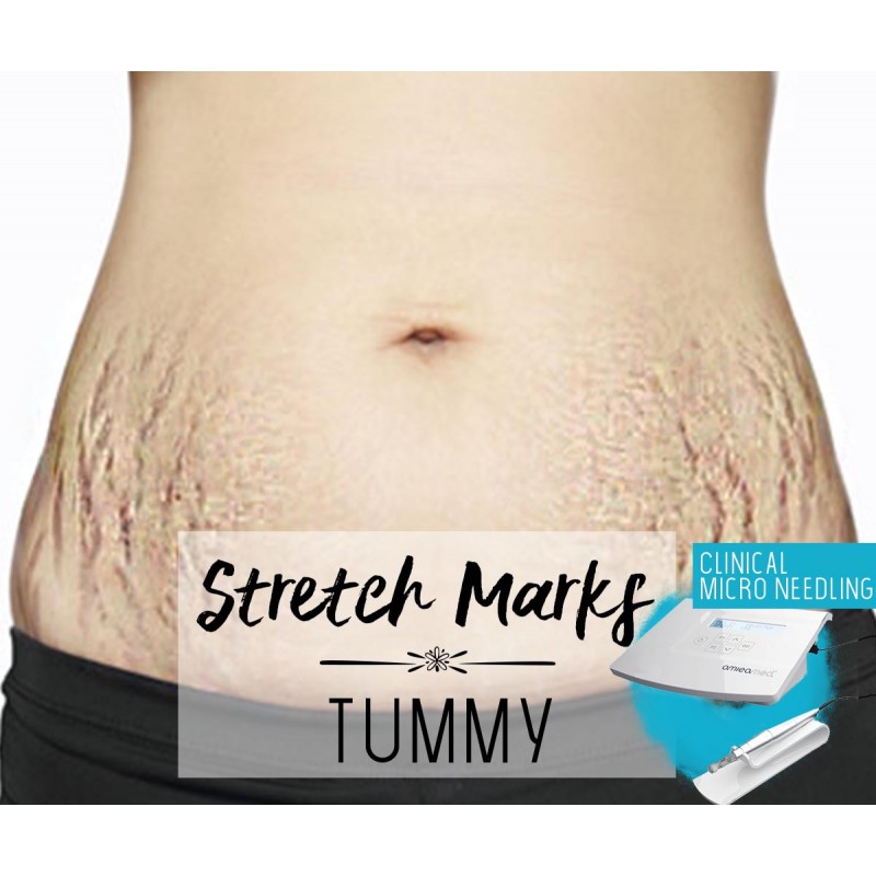Treatment Voucher - Stretch Marks Removal (Tummy) with Clinical Micro Needling