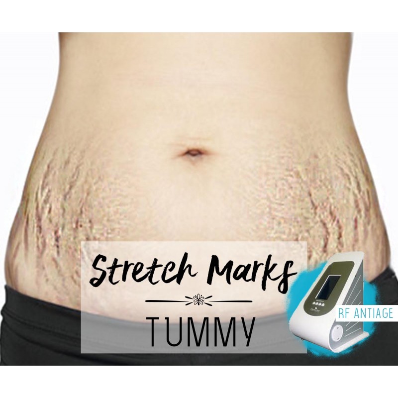 Treatment Voucher - Stretch Marks Removal (Tummy) with RF Antiage