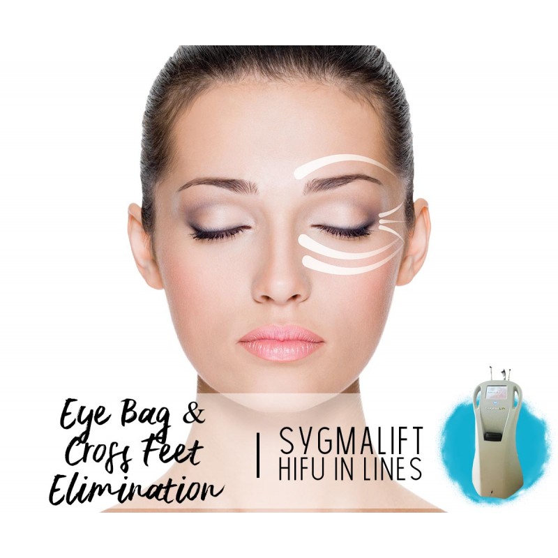 Treatment Voucher - Eye Bag & Cross Feet Elimination with SygmaLift